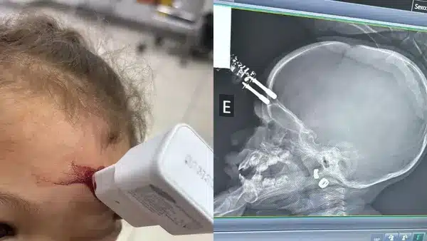 Criança com ferimento na testa sendo tratada com um dispositivo médico, ao lado de uma imagem de raio-X mostrando a cabeça da criança.